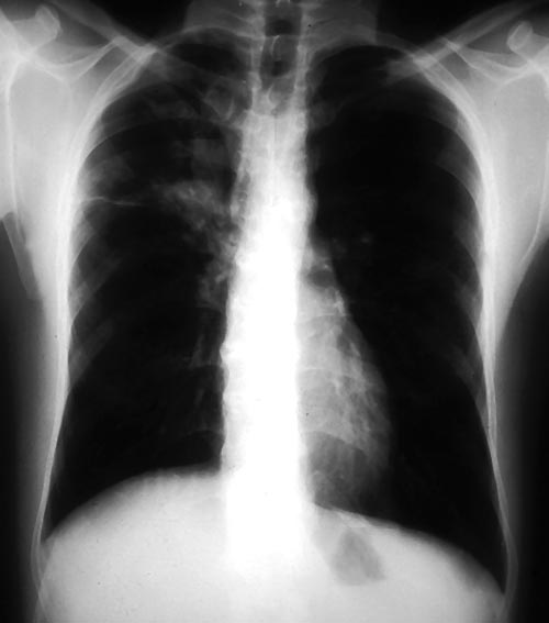 Recurrence of pulmonary shadows 4, pt BJ.