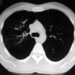 Central bronchiectasis, pt BJ  CT scan of thorax October 1989 showing central bronchiectasis, characteristic of ABPA (and cystic fibrosis).