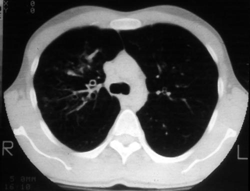 Central bronchiectasis, pt BJ  CT scan of thorax October 1989 showing central bronchiectasis, characteristic of ABPA (and cystic fibrosis).