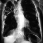 Image C. Angiogram of a right posterior intercostal artery on subtraction film in the early arterial phase showing dilatation of the artery. 