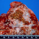 Apex, right lung. Notice pleural thickening, bronchiectasis, parenchymal fibrosis, and fungus ball within an old tuberculous cavern.