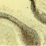 The luminal surface of the cavity covered with lamelliform hyphal growth (Grocott, x 100).