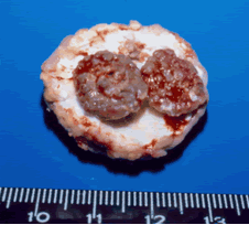 Multiple aspergillomas, Patient CR. Gross pathology showing three fungus balls in one cavity.