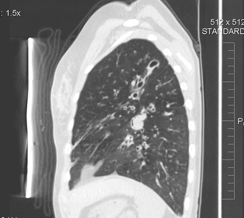 Fig 2 CT - Lateral view showing aspergilloma - left lower lobe. 