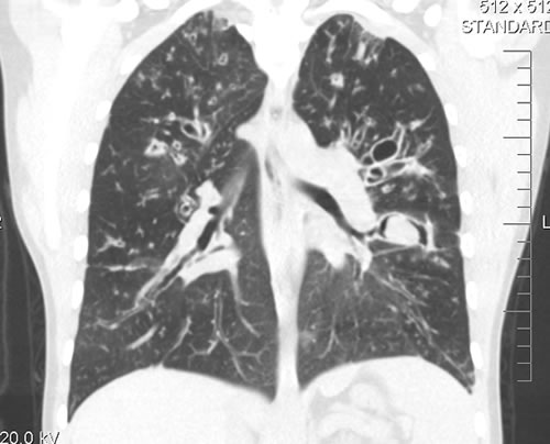 Fig 1 CT scan shows cystic bronchiectasis but a classic aspergilloma with halo sign is seen in left lower lobe