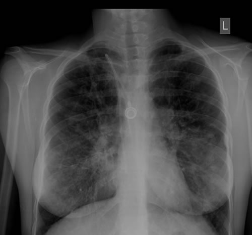 Fig 3 Chest X ray showing bilateral basal bronchiectasis with no definite aspergilloma.