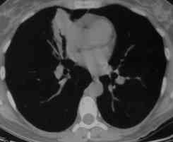 Image M. Allergic Bronchopulmonary Aspergillosis (ABPA) 2/7/96