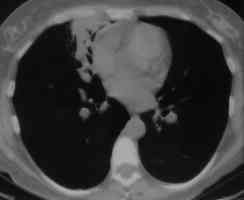 Image N. Allergic Bronchopulmonary Aspergillosis (ABPA) 2/7/96 