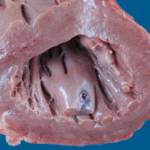 Image C. Mitral valve in Pt CD with endocarditis