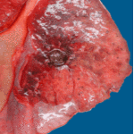 Image B. Hyphal mass in lung Pt CD with endocarditis