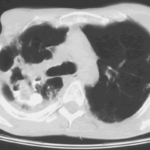 Image B. Post amphotericin B installation.