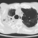 Image C. Scan after instillation of amphotericin B mixed with radiographic contrast medium showing debris surrounded by contrast, in an irregular large apicalcavity.