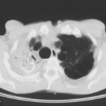 Image D. Scan of chest showing a rim of contrast containing amphotericin B after injection around a large aspergilloma.