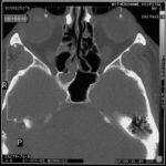 D - Marked involvement of ehmoidal air cells on the right , together with the inferior aspect of the sphenoid sinus. The left side is almost clear of disease.