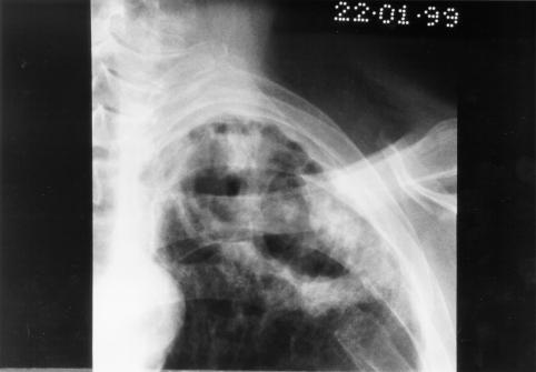 Image C. pt. DM Primary Aspergillus pneumonia (with cavitation) (22.1.99)