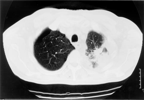 Image G. pt. DM CT scan of left apex (19.2.99)