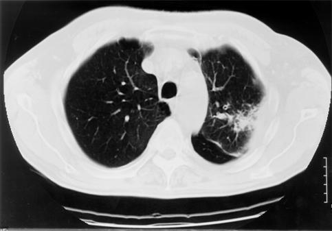 Image H. pt. DM CT scan of left apex (19.2.99). Primary Aspergillus pneumonia (with cavitation)