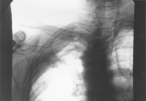 Image E. Pt DM Primary aspergillus pneumonia - needle biopsy (reverse image) (22.2.99)