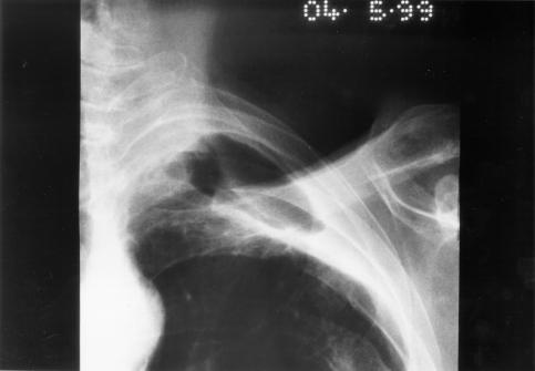 Image F. pt. DM Primary Aspergillus pneumonia (4.5.99)