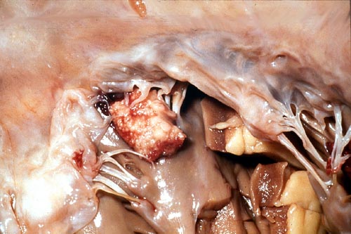 Image C. Mitral valve endocarditis, pt DB