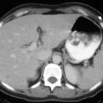 Repeat CT scan of the liver showing almost complete resolution of lesions on itraconazole therapy. 