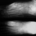 This 17 year old patient with chronic granulomatous disease developed disseminated aspergillosis which included soft tissue and bone infection of both feet. His left foot, after biopsy and on therapy, still shows remarkable swelling.