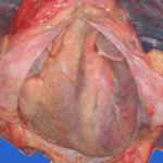 Image D. Pericarditis in Pt CD with endocarditis