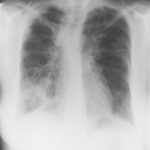 Image G. 19/7/93 Asthma with bronchiectasis and ABPA, with now overt chronic cavitary pulmonary aspergillosis (CCPA), bilaterally Chest x-ray showing extensive shadowing at the right base consistent with a chest infection or plugging, ring shadows and coarse markings throughout the lung fields consistent with bronchiectasis and right apical pleural thickening which has progressed. 