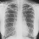 Image B. 4/3/69 Asthma with bronchiectasis.