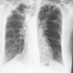 Image J. 11/10/02 Asthma with bronchiectasis, ABPA and CCPA which has progressed. 