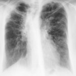 Image H. 05/06/95 Asthma with bronchiectasis, ABPA and CCPA with possible airway plugging due to ABPA. 