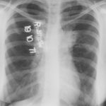 Image C. 19/10/71 Asthma with bronchiectasis.