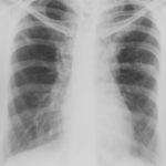 Image D. 22/9/81 Asthma with bronchiectasis and first radiological clue of ABPA.