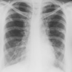 Image E. 3/11/81 Asthma with bronchiectasis and first radiological clue of ABPA.