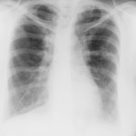 Image F. 17/9/85 Asthma with bronchiectasis and ABPA, with first clue of chronic cavitary pulmonary aspergillosis (CCPA). 