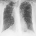 Image I 08/03/99 Asthma with bronchiectasis, ABPA and CCPA with obvious progression of bronchiectasis, and ? ABPA-related collapse left side Chest x-ray showing marked scoliosis, stable mild left upper lobe fibrosis and cavity formation, and stable right upper lobe pleural thickening.