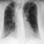 Image K. 05/04/04 Asthma with bronchiectasis, ABPA and CCPA with large airway disease of uncertain cause.  