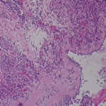 Image C. Lung biopsy tissue