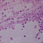 Image E. Mucous plug shows layering with eosinophilic debris and crystals (Images F & G). Plug has appearance of allergic mucin.