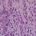 Image B. Evidence of squamous metaplasia with reactive atypia. There is no evidence of granulomatous inflammation or malignancy. Congo red and Grocott stain revealed no fungal elements.