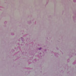 Image F. Mucous plug shows Charcot-Leyden crystals