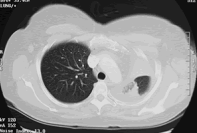 Image C. CT scan of the chest (Oct 04) shows extensive collapse of the left lung with only slight aeration of the left upper lobe. No definite central mass can be identified and no lymphadenopathy was visible. There is a small left sided pleural effusion. The right lung is normal. “The overall appearances remain highly suspicious of a central broncho-occlusive lesion on the left side.