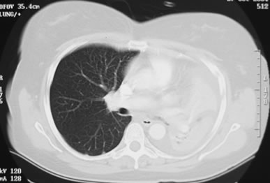 Image D. CT scan of the chest (Oct 04) shows extensive collapse of the left lung with only slight aeration of the left upper lobe. No definite central mass can be identified and no lymphadenopathy was visible. There is a small left sided pleural effusion. The right lung is normal. “The overall appearances remain highly suspicious of a central broncho-occlusive lesion on the left side.