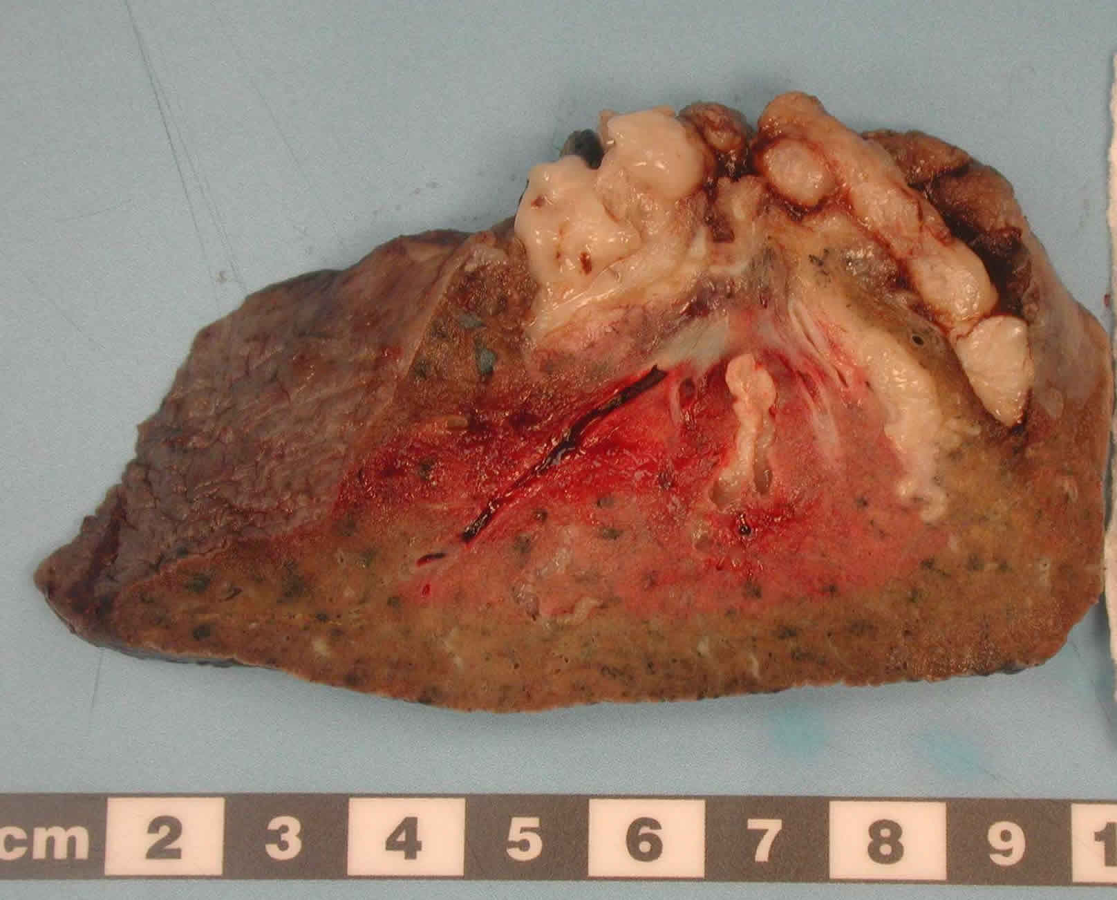 Image E. Cut surface of lung, following pneumonectomy, showing massive mucous impaction of the major airways and almost complete distal consolidation.