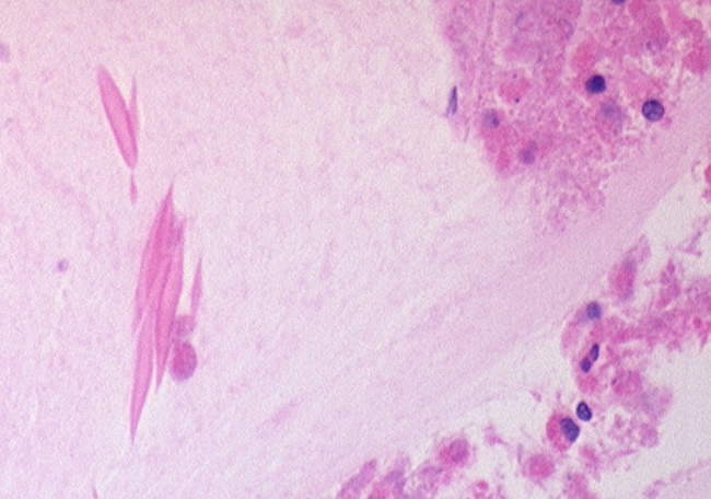 Image F. Mucous containing Charcot-Leyden crystals, stained with H & E