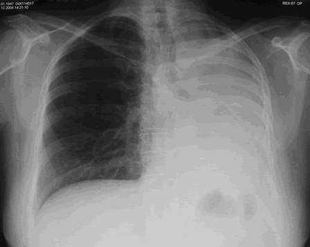 Image B. Progression of the process was documented in Dec (04) by chest x-ray, and bronchoscopy had not identified a malignant lesion. 