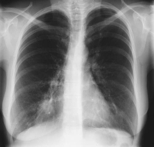 Image D. 01/98 Exacerbation showing right lower lobe opacification 