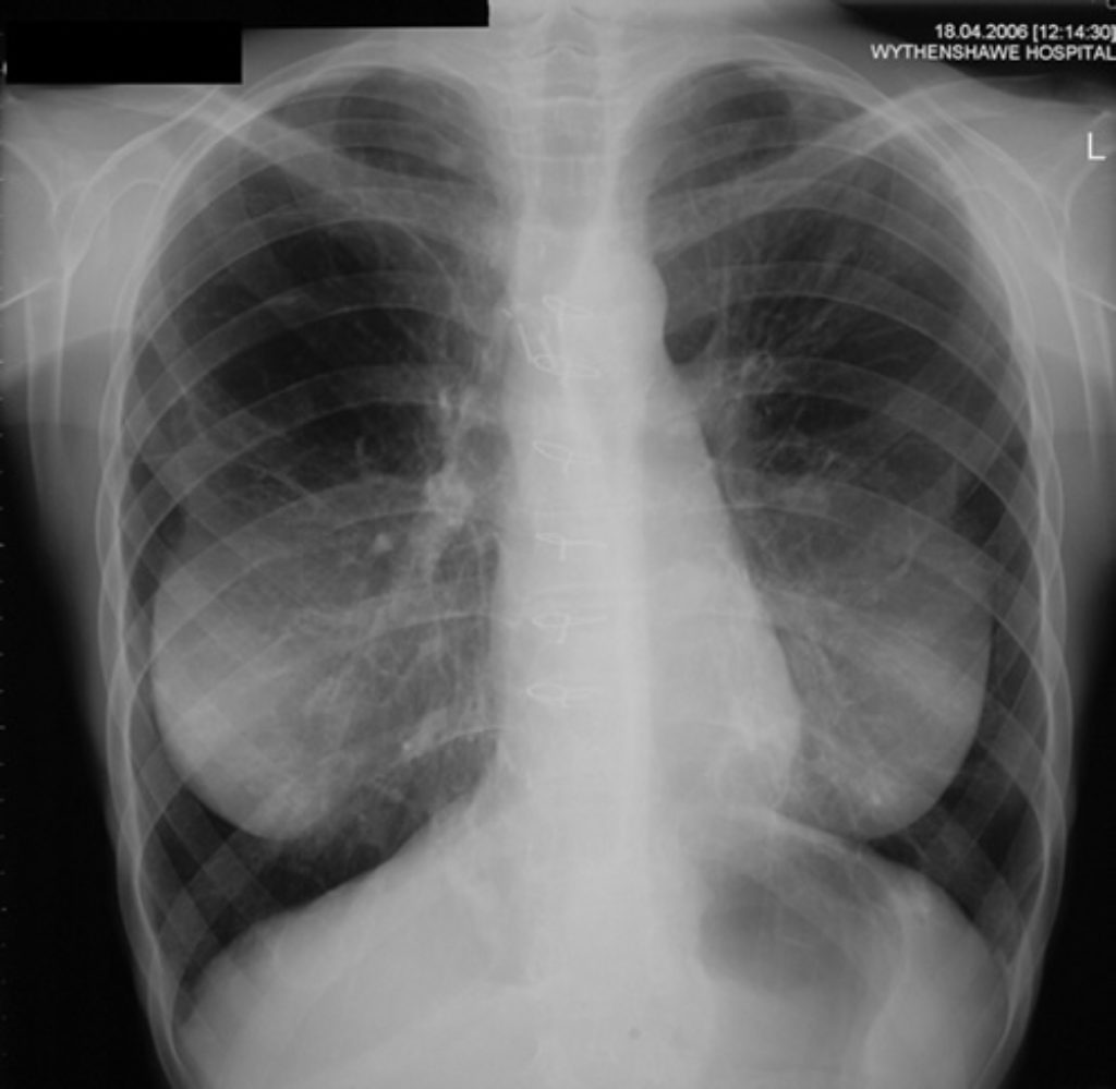 Subacute invasive aspergillosis in CF after heart/lung transplant (55 ...