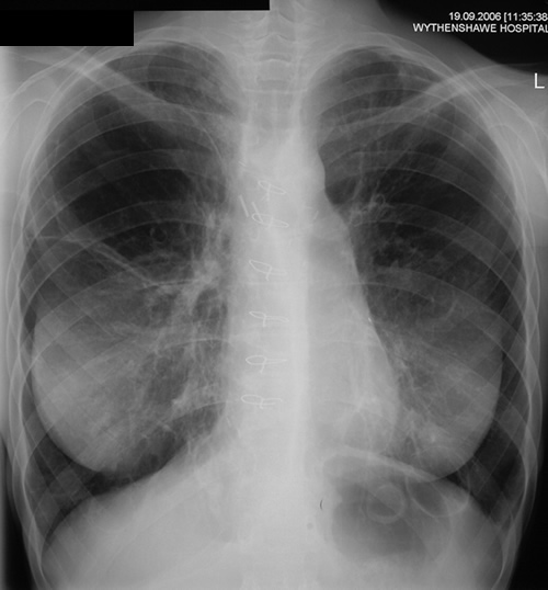 Chest Xray 19/09/06 Obvious enlargement and greater wall thickness of the ‘cysts’ in the left lower lobe, one with some fluid within it, with less evidence of a ‘cyst’ in the right lower lobe.