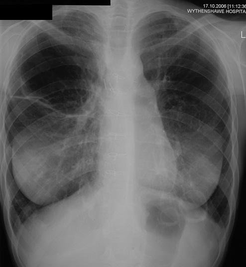 Chest Xray17/10/06 Interval enlargement of the 2 largest and most prominent cavitary lesions in the left lower lobe, with thicker walls and possibly containing some fluid. Probable development of a new cavitary lesion in the right lower lobe, just behind the diaphragm.